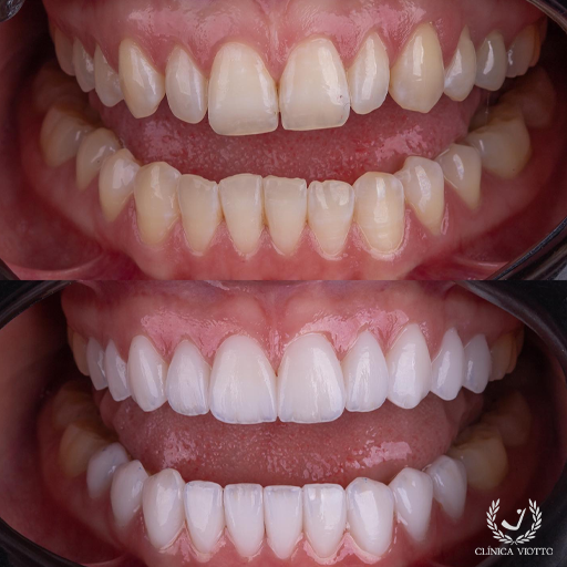 Clareamento Dental Duradouro e Resultado Comprovado