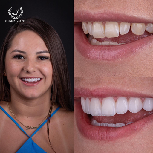 Clareamento Dental Estético