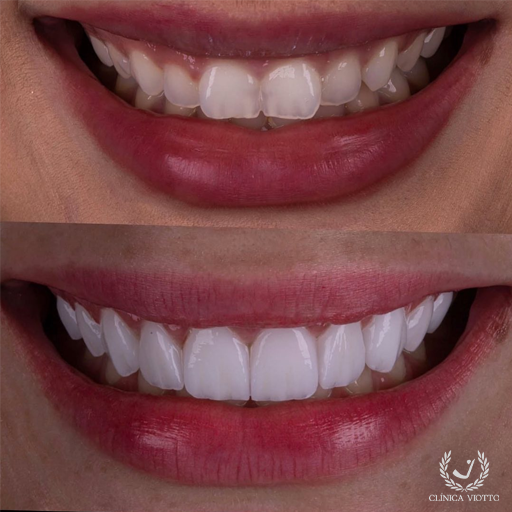 Facetas de Porcelana com Dr. Viotto Sorriso Natural