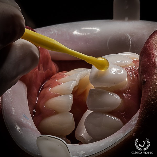 Facetas de Porcelana Naturais com Especialista Premiado