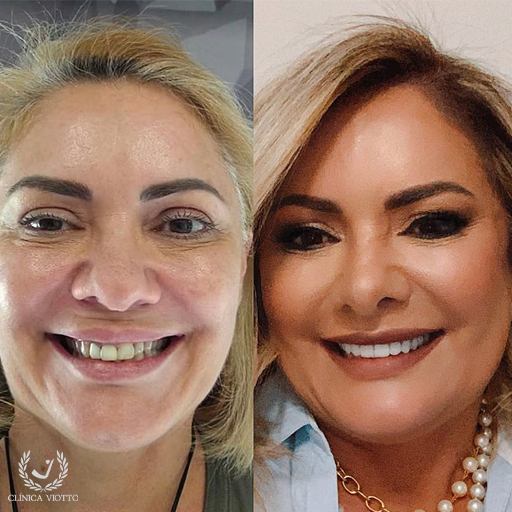 Harmonização Facial