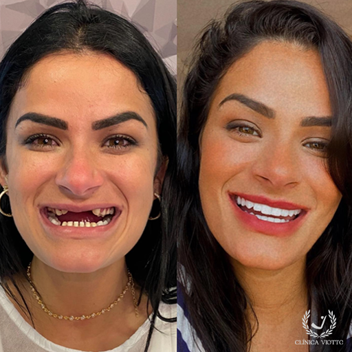 Implante dentário preço